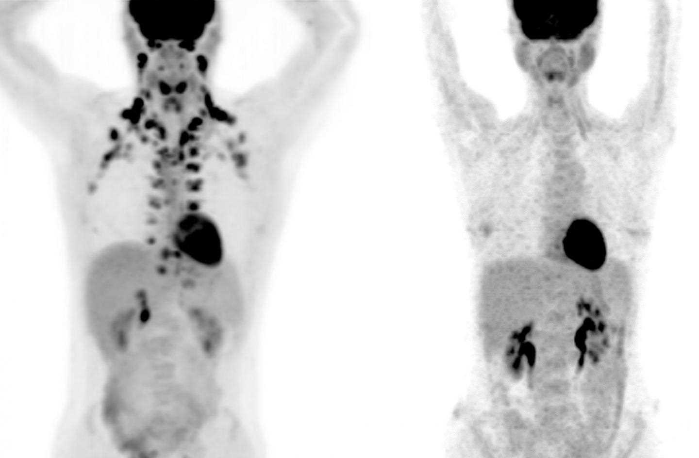 ПЕТ-зображення людини з бурим жиром (зліва) та без нього (справа). Andreas G. Wibmer / Heiko Schöder / MSKCC