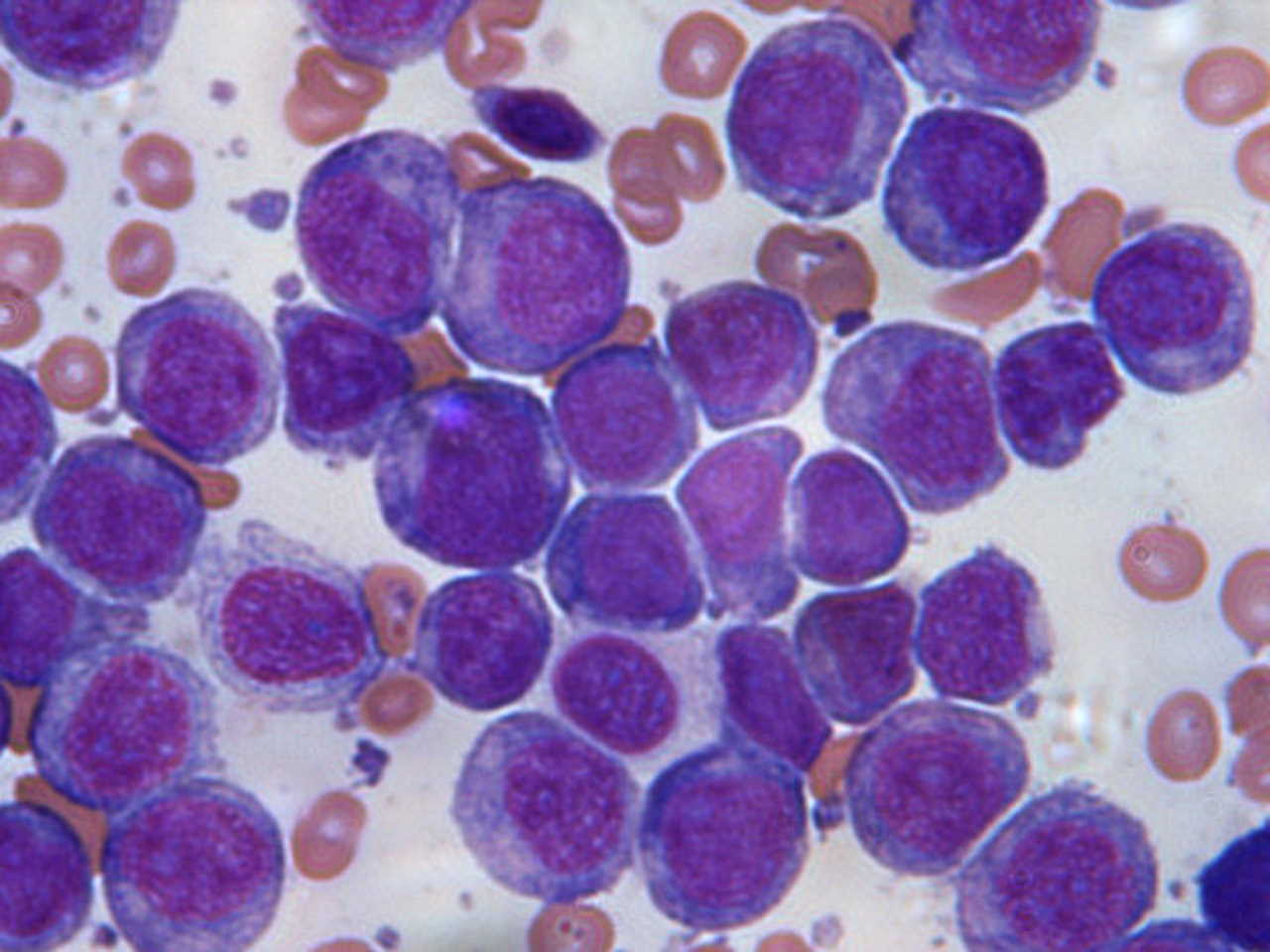 Клітини крові хворої на гостру мієлоїдну лейкемію людини. Genome Research Limited