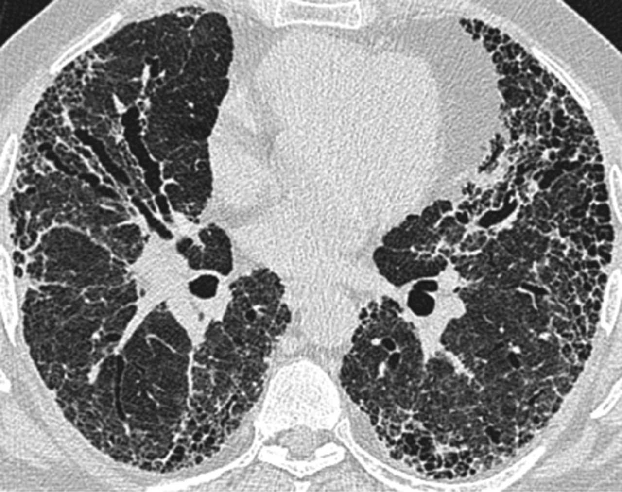 Легеневий фіброз на зображенні комп'ютерної томографії. BMJ Thorax
