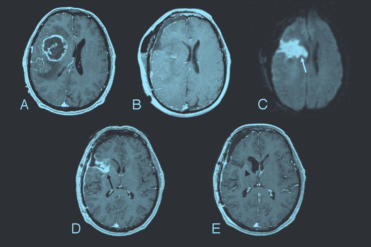 МРТ мозку чоловіка з гліобластомою. S. Cha / American Society of Neuroradiology, 2006