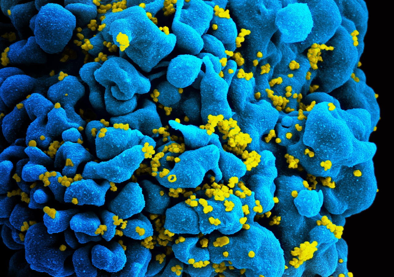 T-лімфоцити інфіковані вірусом імунодефіциту людини (жовто-зелений) під сканувальним електронним мікроскопом. NIAID / Wikimedia Commons