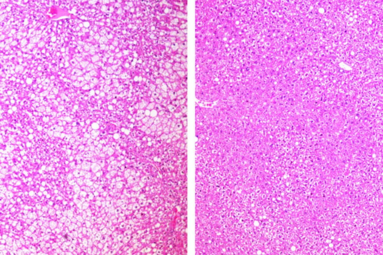 Тканини печінки мишей на західній дієті: зліва — помітна значна кількість жиру в клітинах нелікованої тварини, справа — зменшений вміст жиру в клітинах миші, лікованої протираковим препаратом. Yiming Zhang et al. / Cell Reports Medicine, 2022