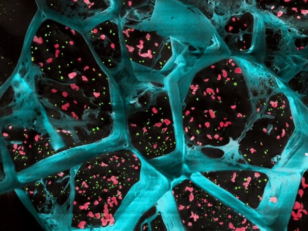 Гідрогель у великому збільшенні (синій колір) із інкапсульованими тромбоцитами, що активують Т-клітини, та наночастинками з препаратом для пригнічення ракових клітин (зелений колір). University of Wisconsin-Madison