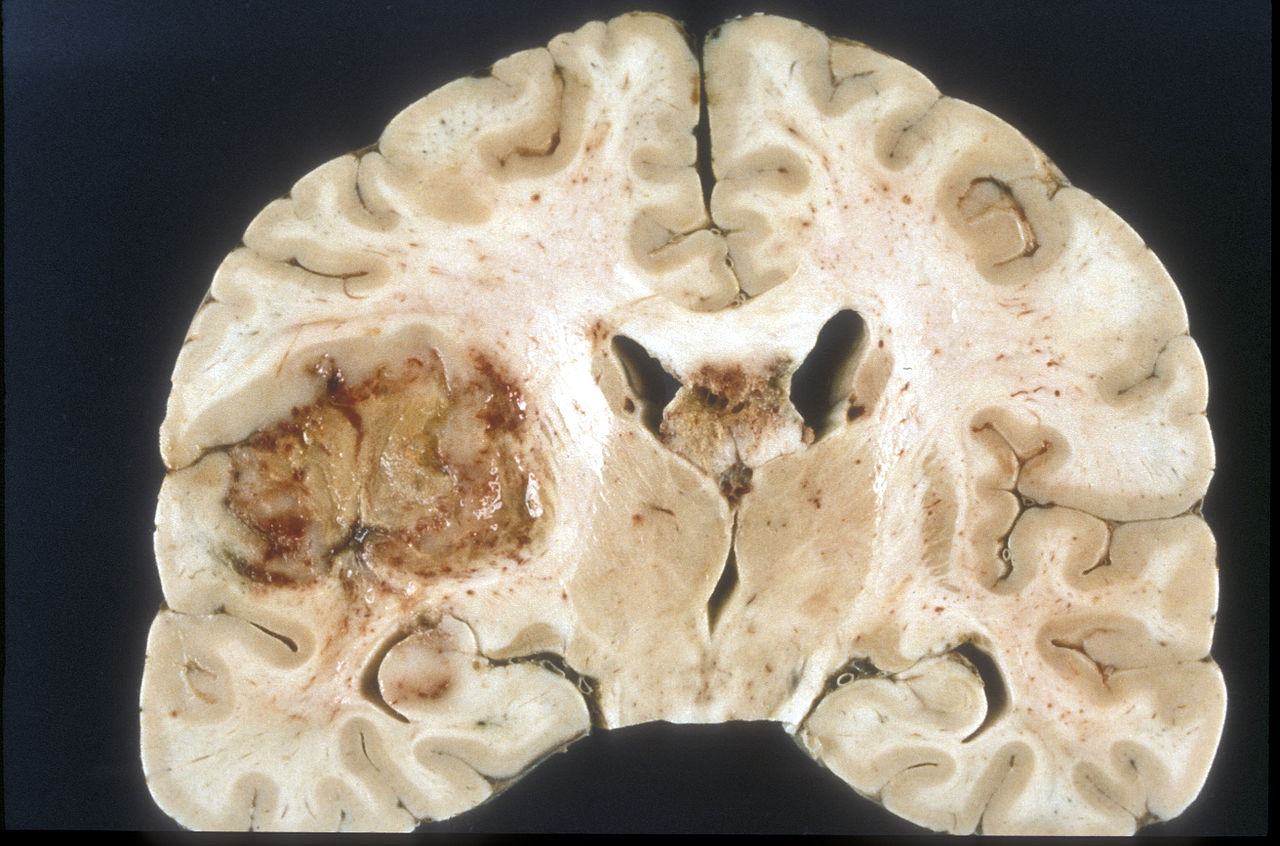 Зображення мультиформної гліобластоми людини – злоякісної пухлини мозку. Sbrandner / Wikimedia Commons