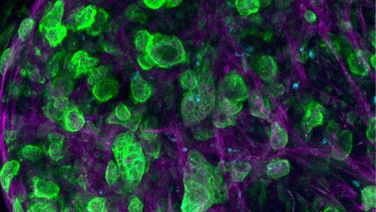 Зображення клітин аденокарциноми протоків підшлункової залози, отримане за допомогою конфокальної мікроскопії.&amp;nbsp;Professor Alvaro Mata/ University of Nottingham