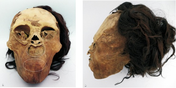Спотворення обличчя жінки, яке проявляється у надмірному розтягненні шкіри та закриванням нею рота й ніздрів, що не може бути пояснено природними посмертними процесами. Standen et al. / Journal of Anthropological Archaeology, 2021