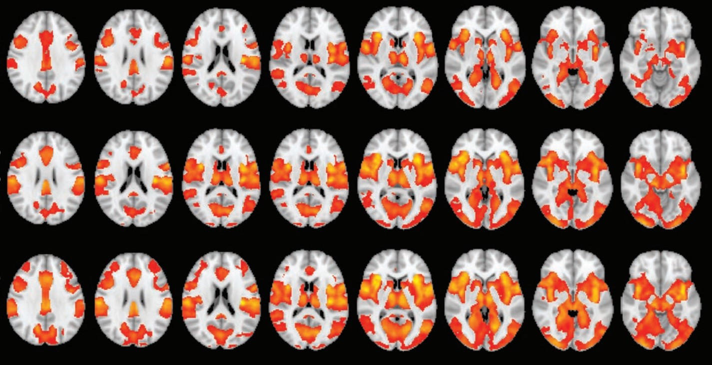 Активація мозку при ностальгії та переживанні болю. Ming Zhang et al. / JNeurosci, 2022