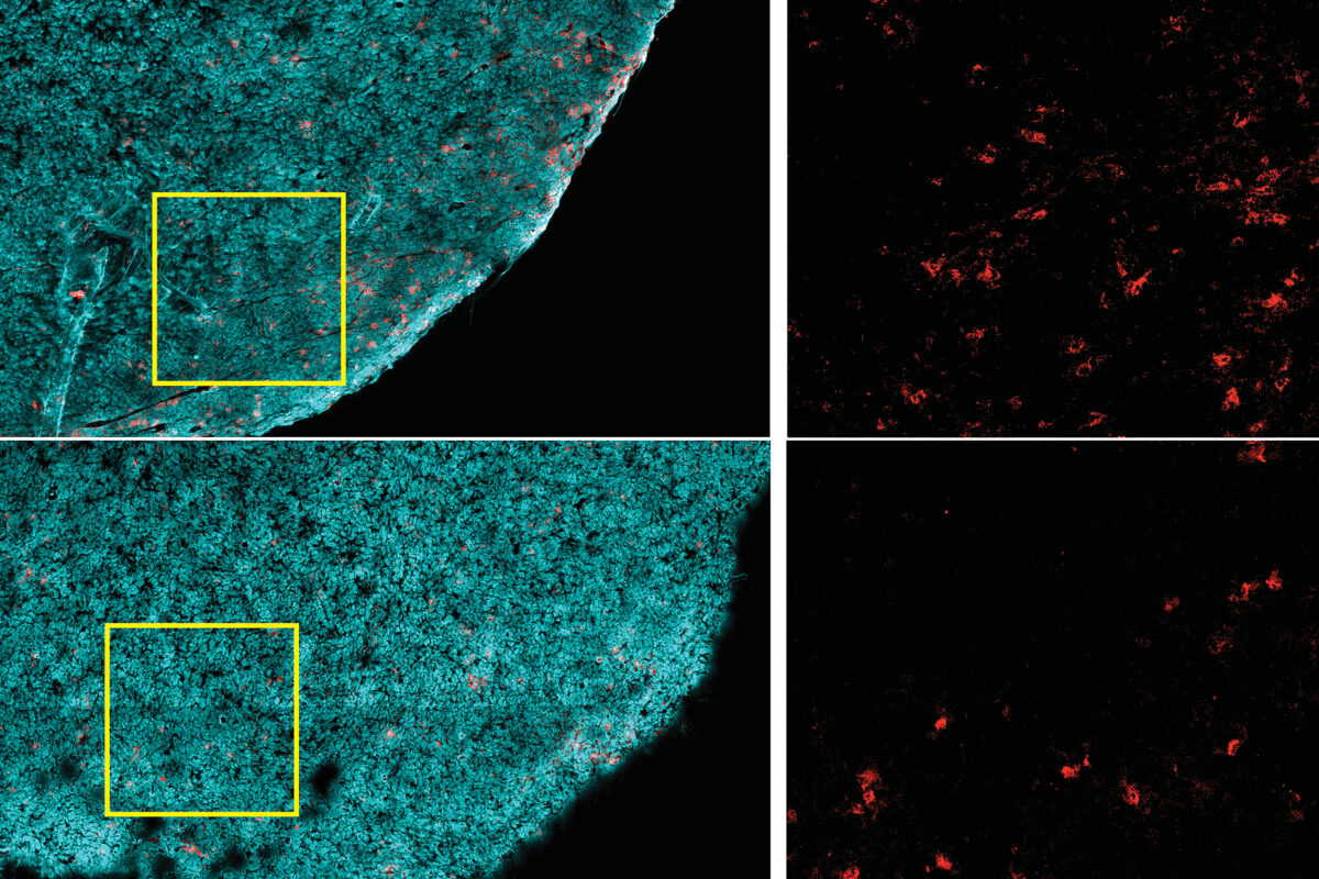 Кількість CD8+ T-клітин (червоні) у пухлинах (бірюзові) вища у мишей, що споживають низьку кількість жирів (верхній ряд), на відміну від мишей на дієті з високим вмістом жирів (нижній ряд). Ringel et al. /  Cell, 2020