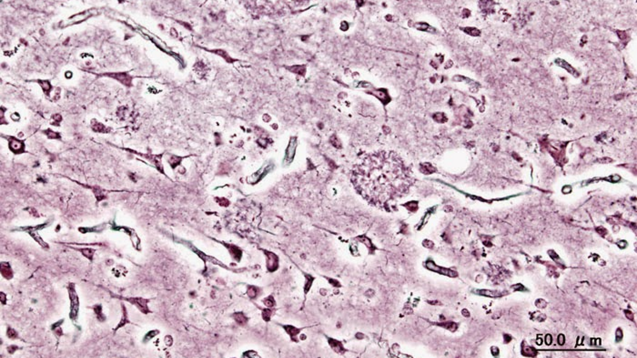 Мікроскопічне зображення мозкових тканин пацієнта з хворобою Альцгеймера. KGH&amp;nbsp;