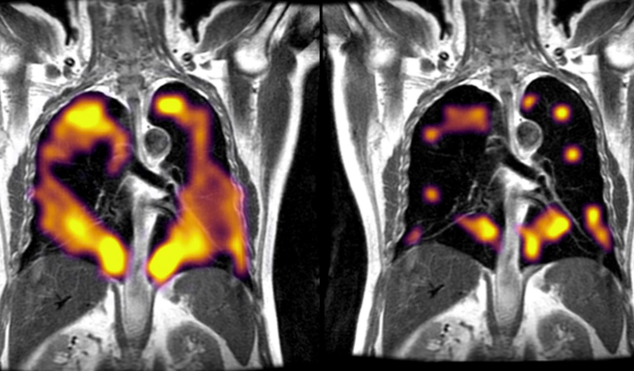 Зображення, отримане новою технологією МРТ, під час якої обстежуваний вдихав ксенон для виявлення ділянок легень із погіршенням вентиляції. University of Oxford Department of Oncology