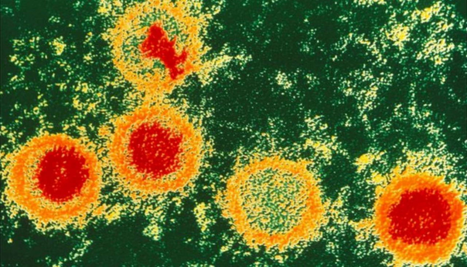 Зараження вірусом Епштейна — Барр назвали чинником розсіяного склерозу