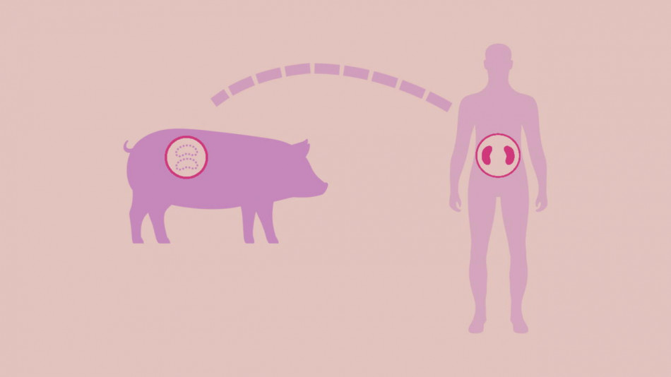 Одразу дві нирки генетично модифікованої свині трансплантували людині